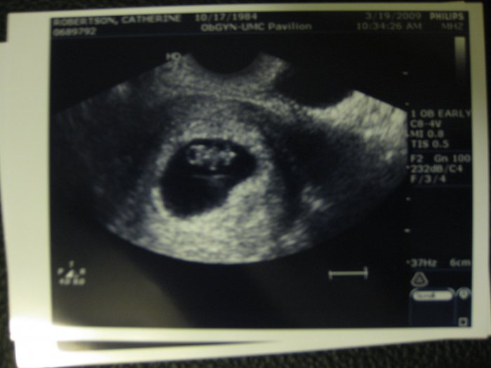 Ultrasound, 8 weeks