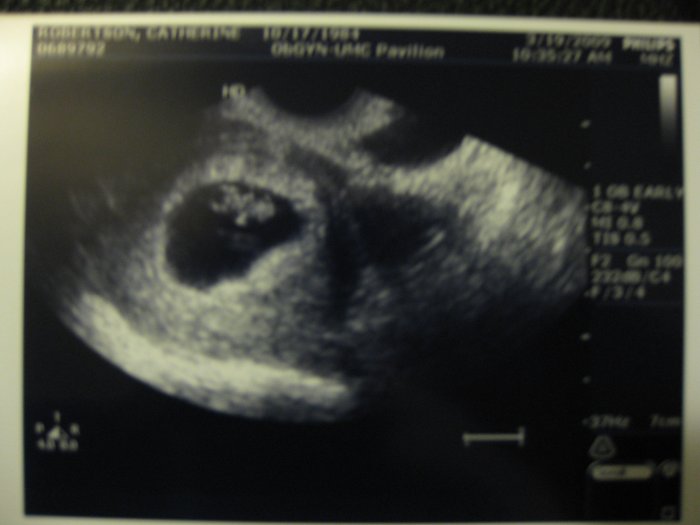 Ultrasound, 8 weeks