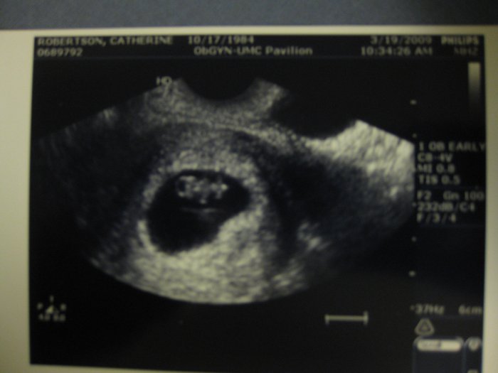 Ultrasound, 8 weeks