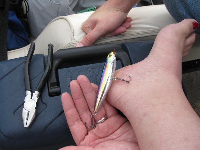 Louann's foot, with the size #4 treble stuck in it, all the way to the shank.